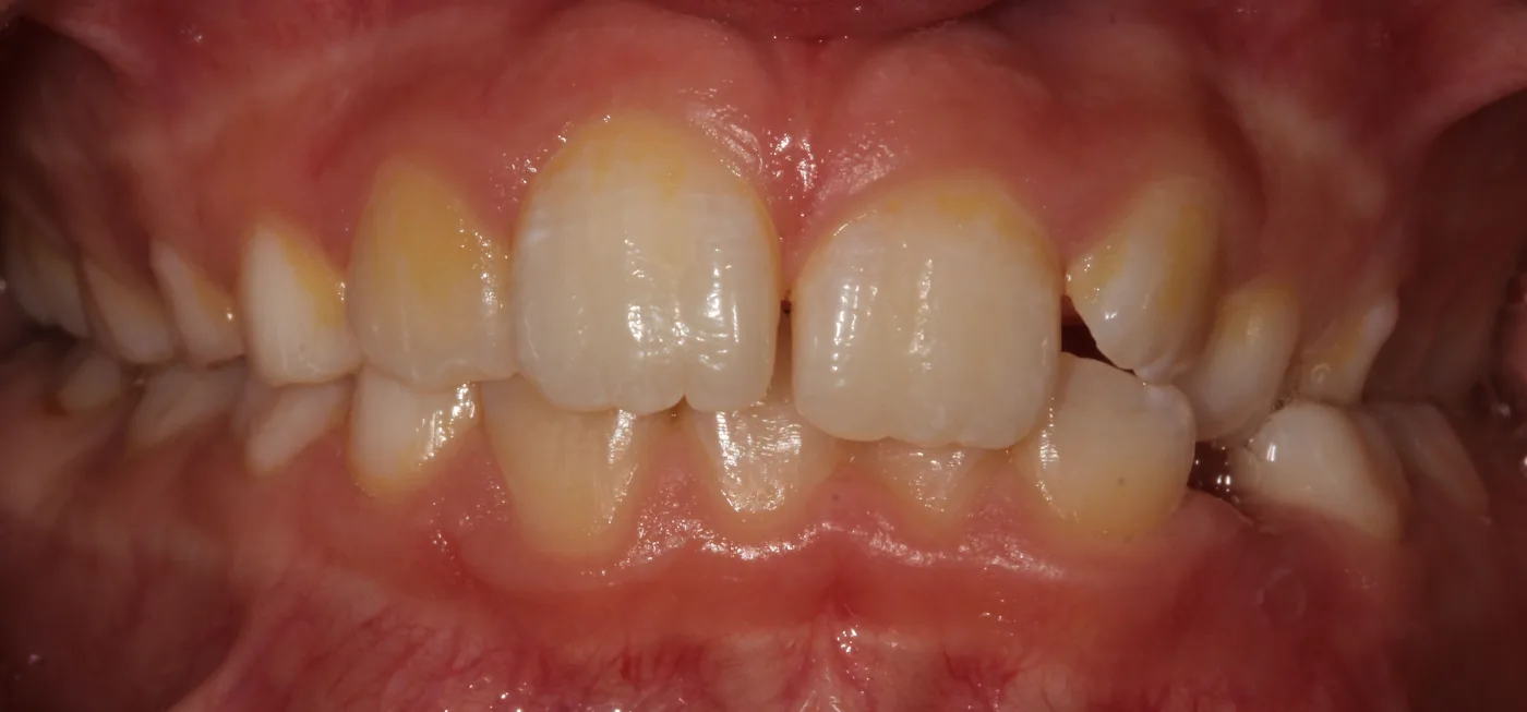 Before treatment, front view of bite